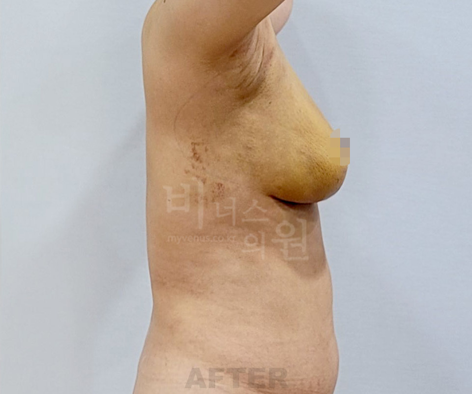 유방 표층 지방흡입 수술 후 측면 반대쪽 비너스의원