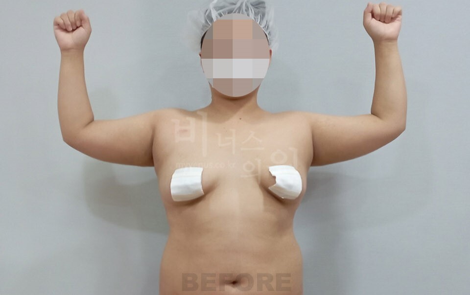 팔 지방흡입 수술 전 정면 만세 자세 겨드랑이 라인 비너스의원