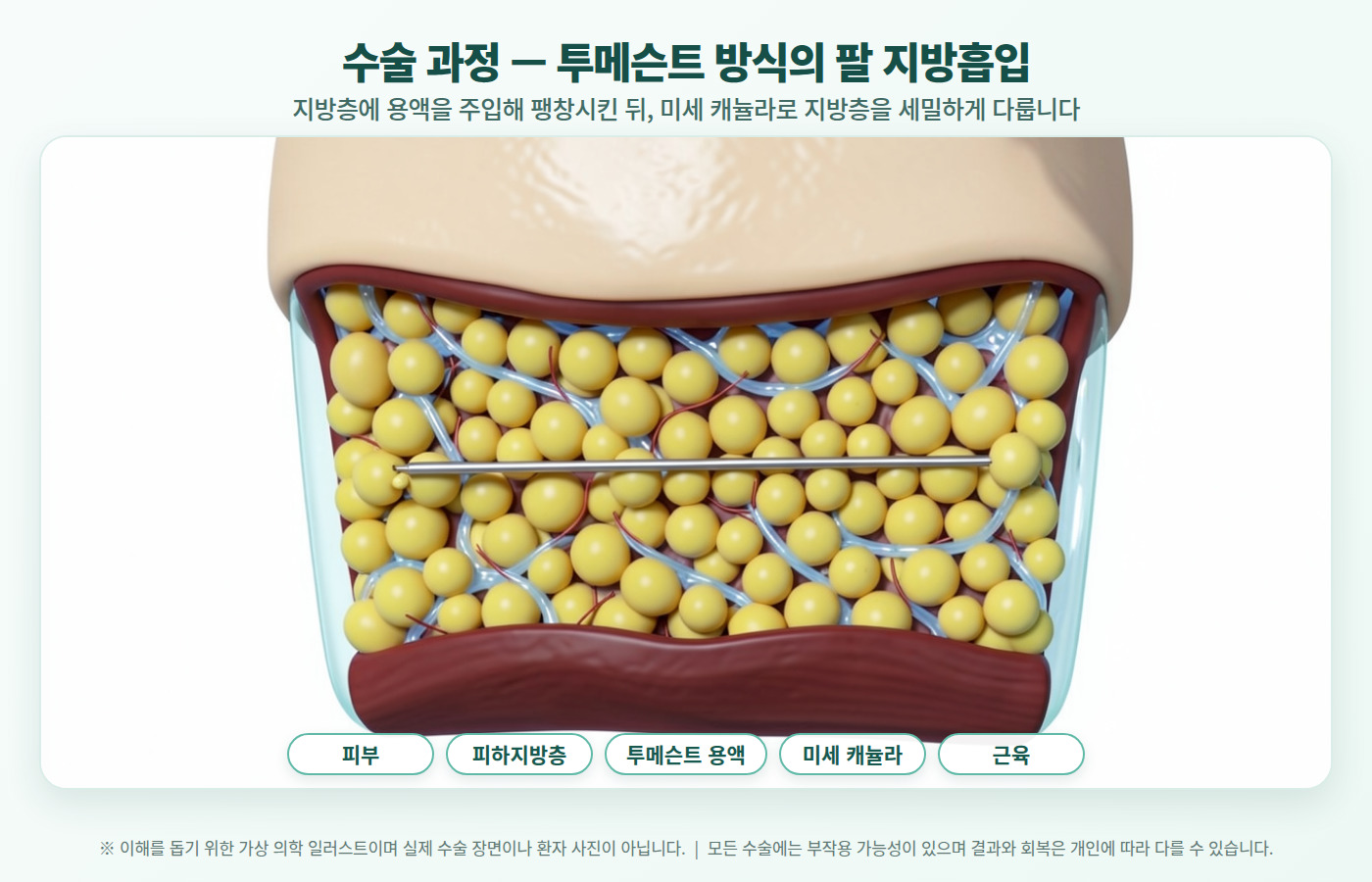 팔뚝 지방흡입 수술 디자인부터 관리까지 단계별 체크리스트 인포그래픽