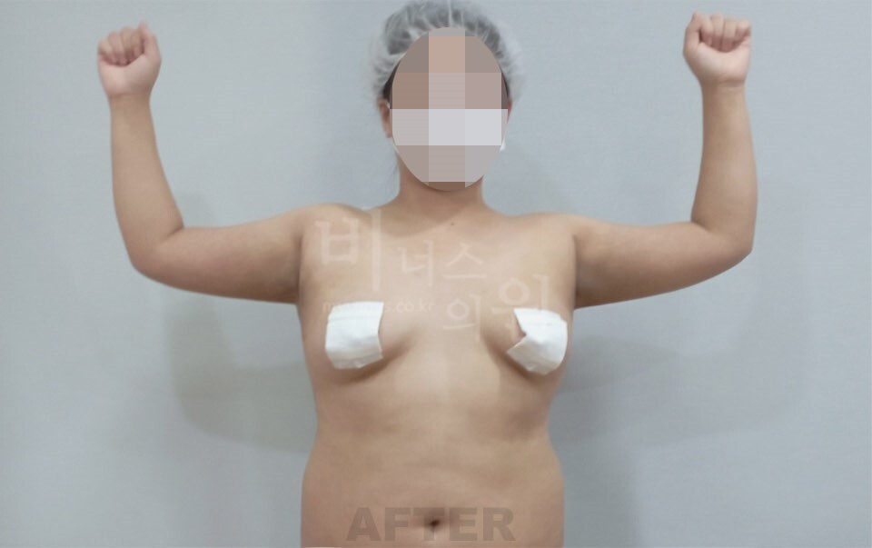 팔 지방흡입 수술 후 정면 만세 자세 겨드랑이 라인 비너스의원