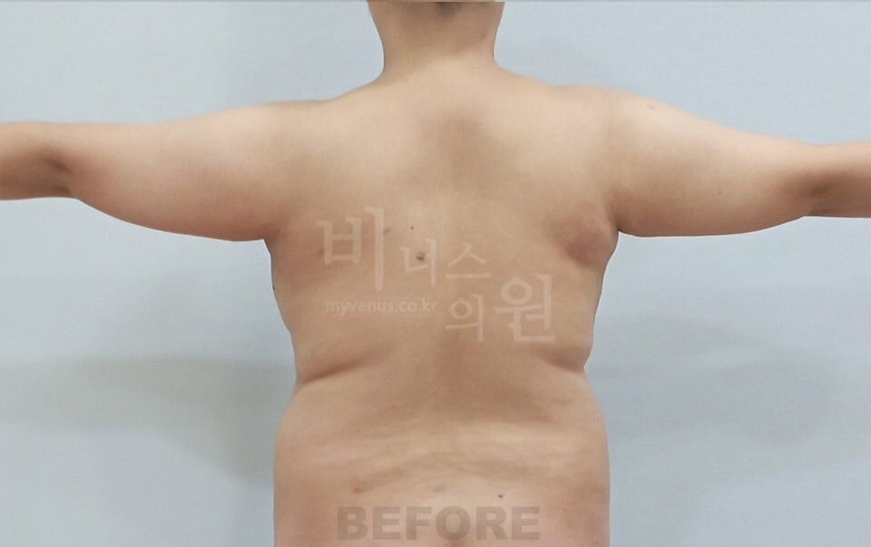팔 지방흡입 수술 전 후면 팔 벌림 자세 비너스의원