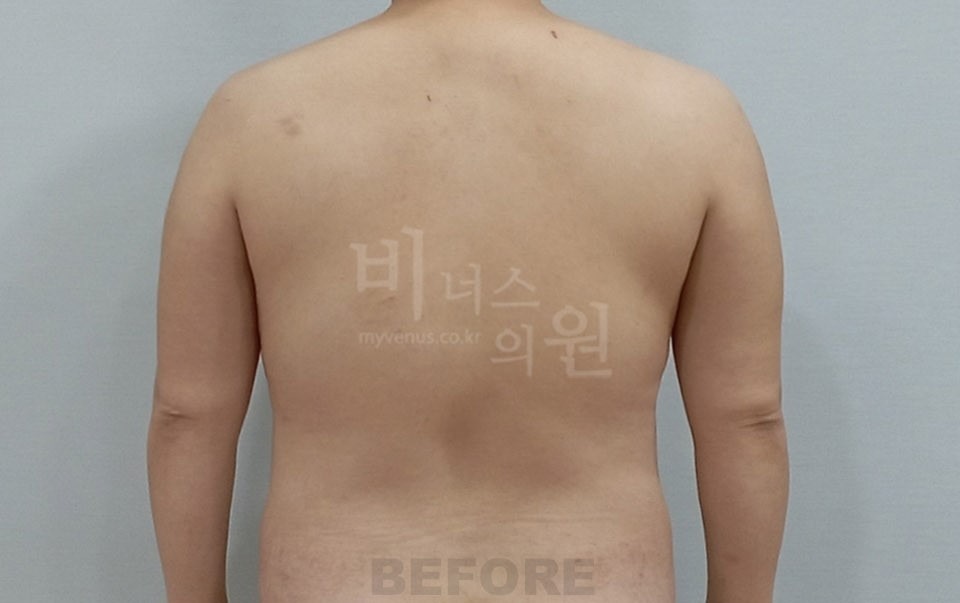 팔 지방흡입 수술 전 후면(팔 내림) 비너스의원