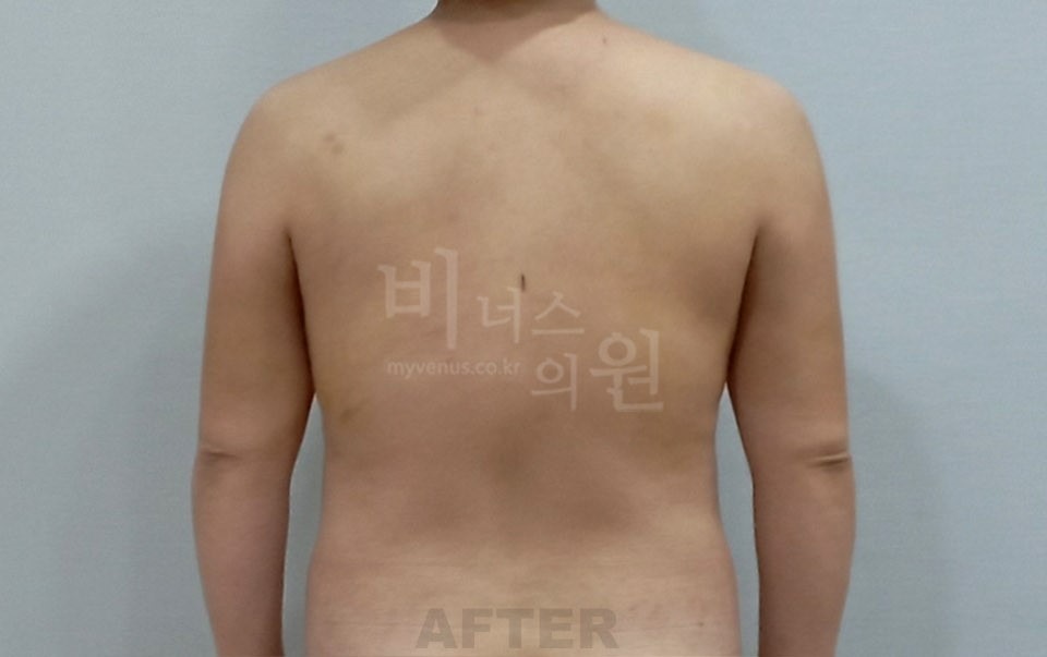 팔 지방흡입 수술 후 후면(팔 내림) 비너스의원