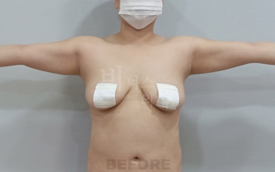 팔 지방흡입 수술 전 정면(팔 벌림) 비너스의원