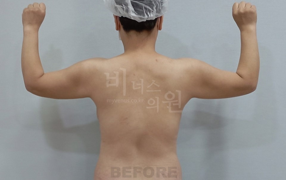 팔 지방흡입 수술 전 후면(팔 올림) 비너스의원