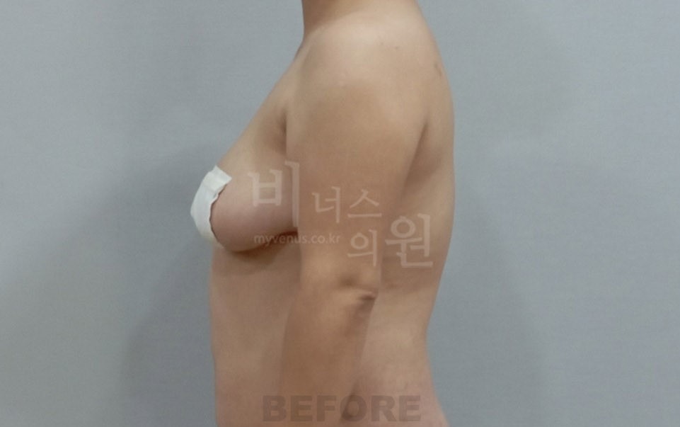 팔 지방흡입 수술 전 측면 ① 비너스의원