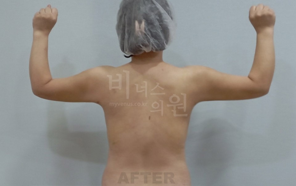 팔 지방흡입 수술 후 후면(팔 올림) 비너스의원