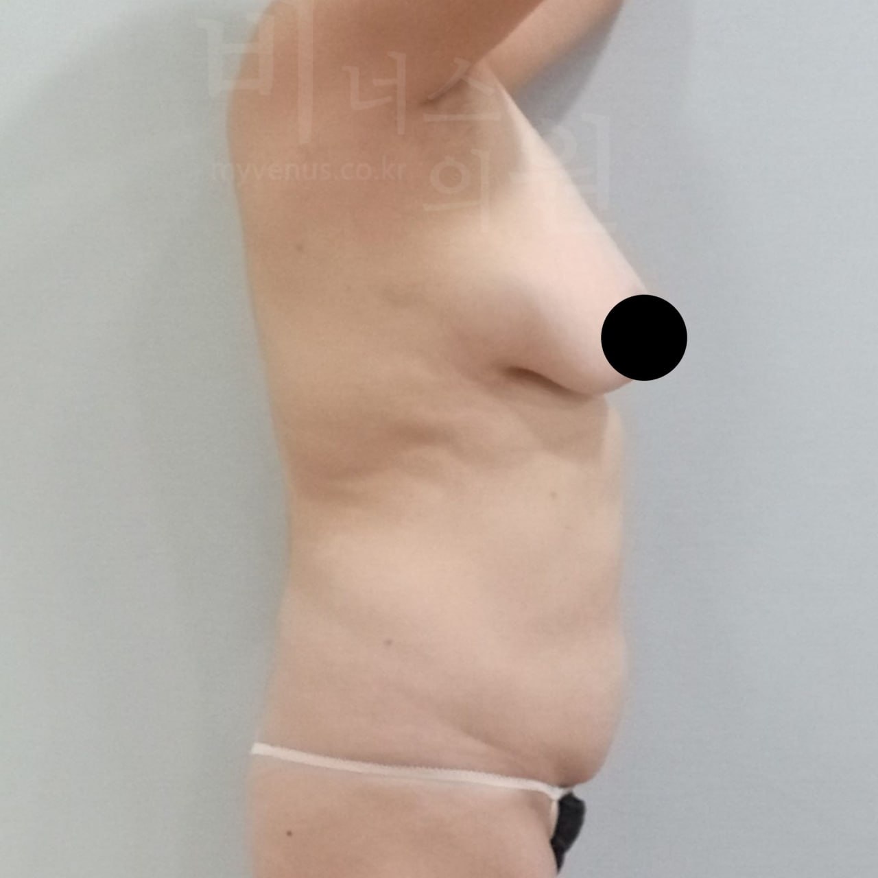가슴축소 지방흡입 수술 전 측면