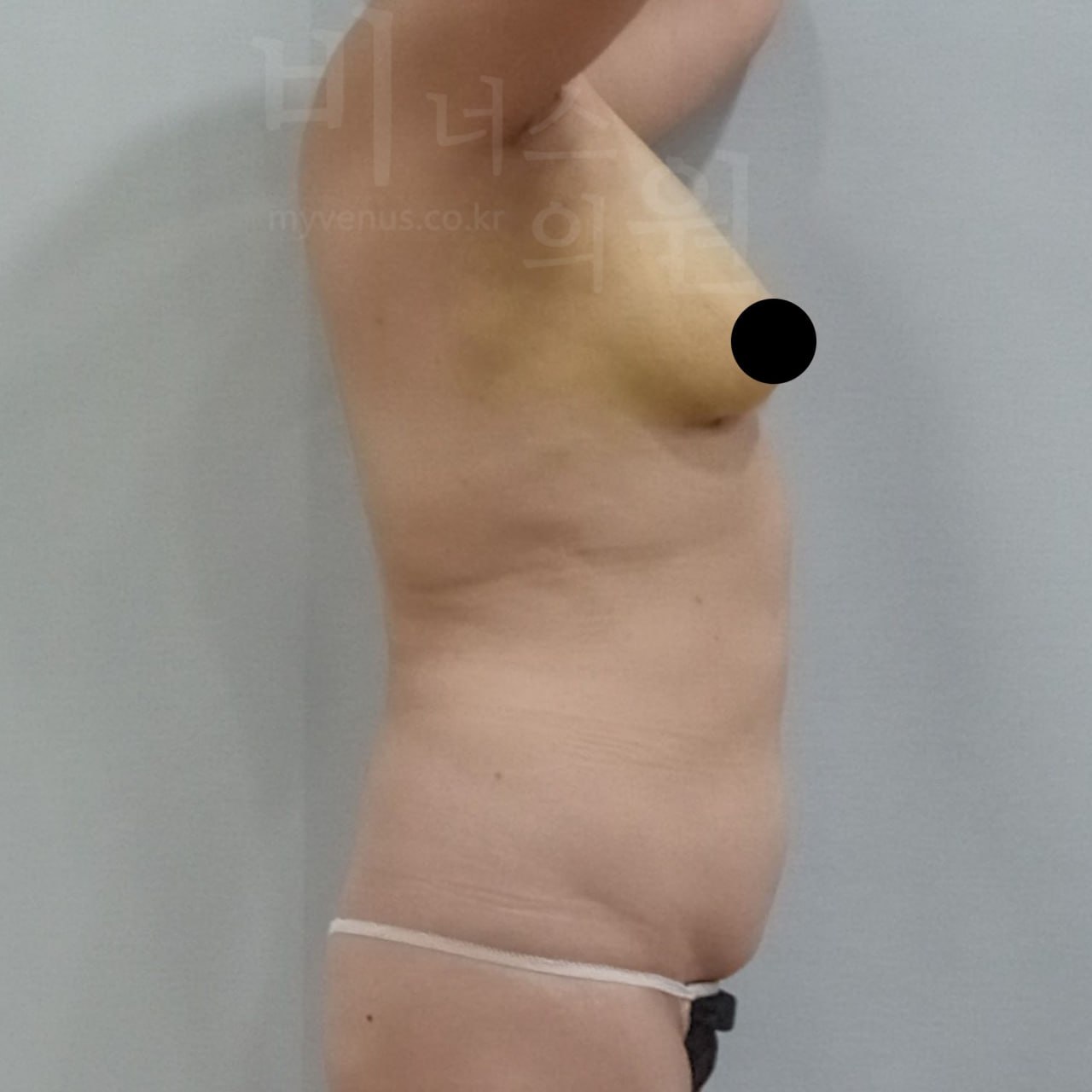 가슴축소 지방흡입 수술 후 측면