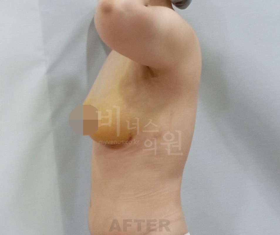 가슴지방흡입_2.JPG