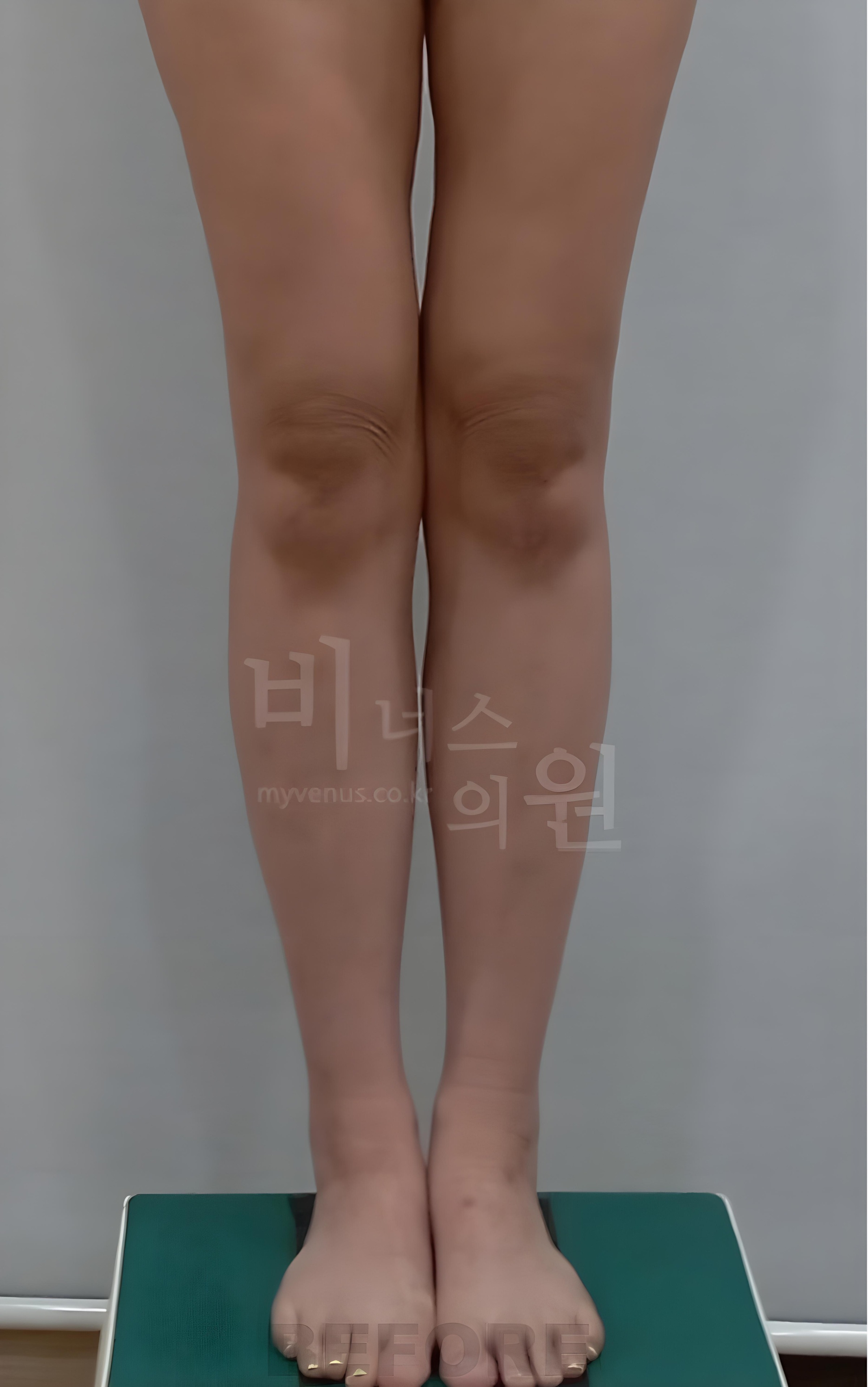 종아리 지방흡입 수술 전 정면 비너스의원