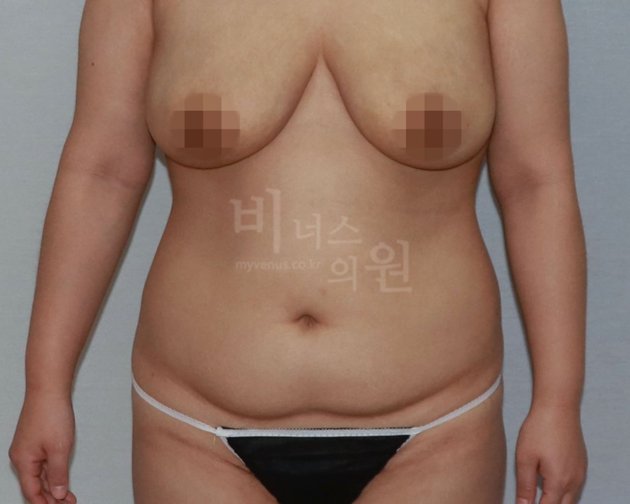 복부 지방흡입 수술 전 정면 케이스1 비너스의원