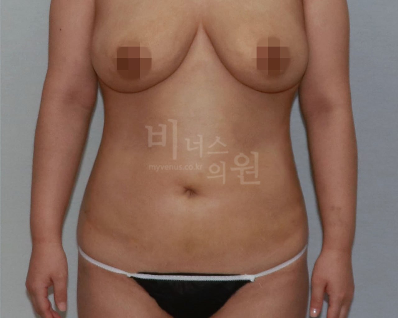 복부 지방흡입 수술 후 정면 케이스1 비너스의원