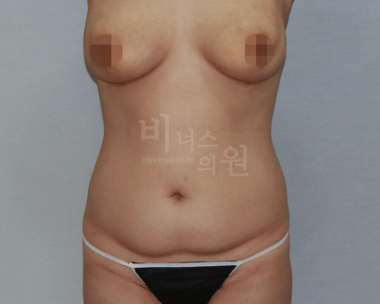 복부 지방흡입 수술 전 정면 케이스2 비너스의원
