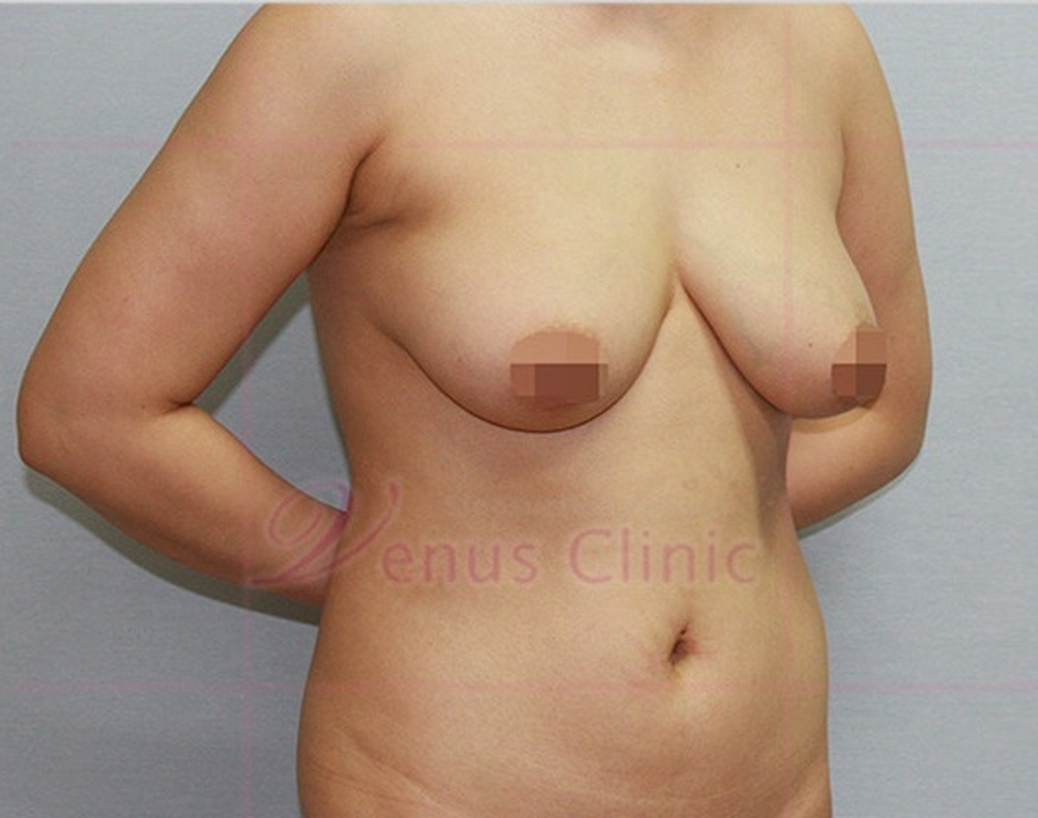 가슴축소 지방흡입 수술 전 우측면