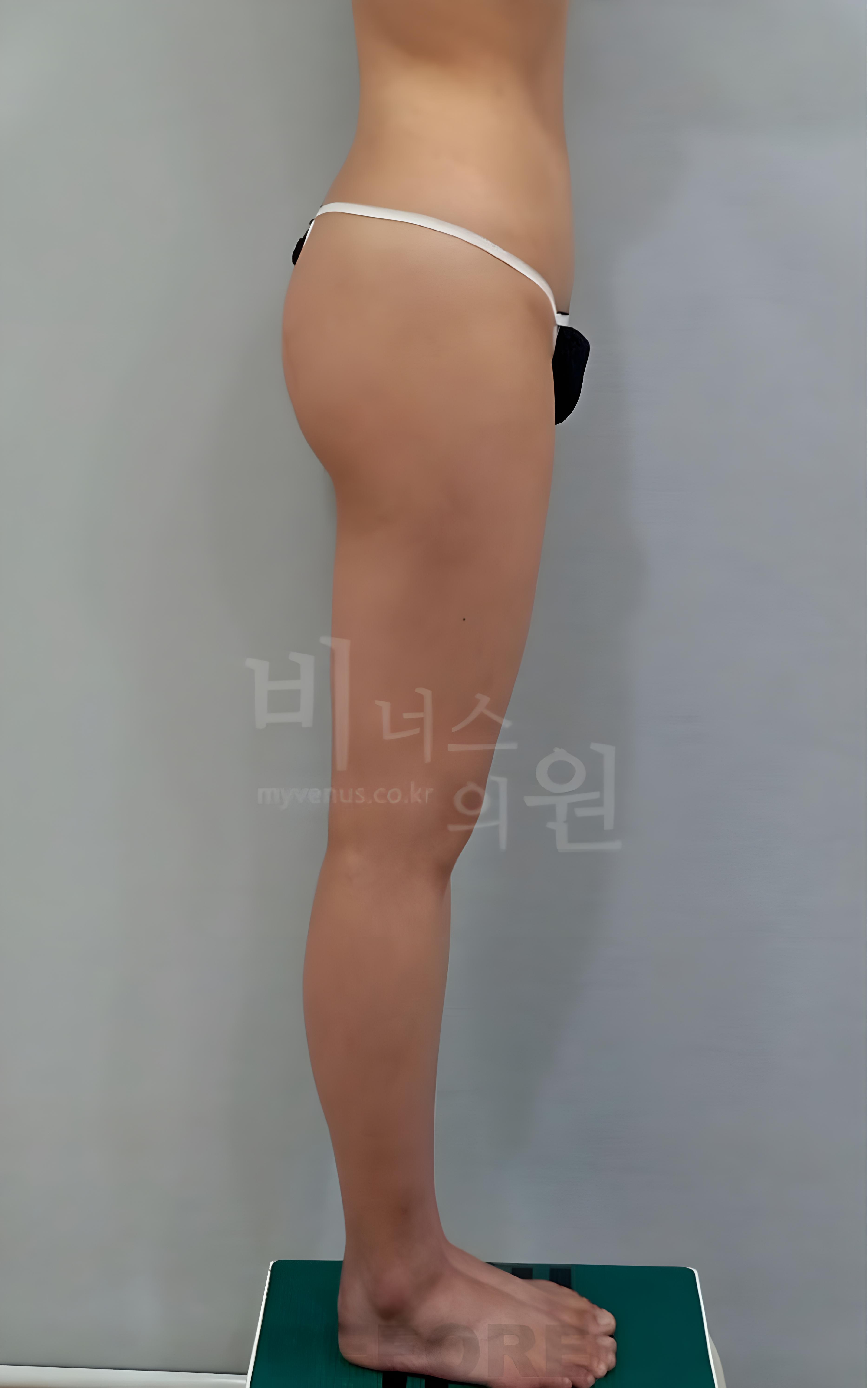 엉덩이축소 지방흡입 수술 전 측면 비너스의원