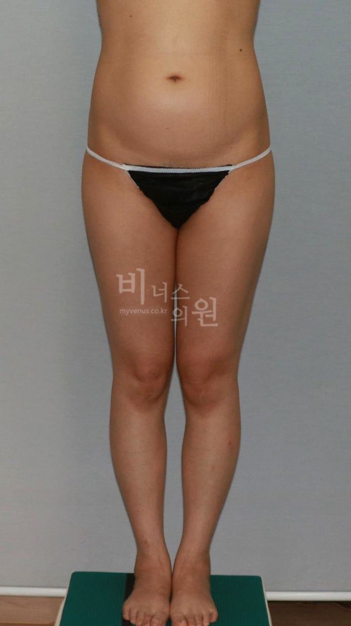 엉덩이·허벅지 지방흡입 수술 후 정면 비너스의원