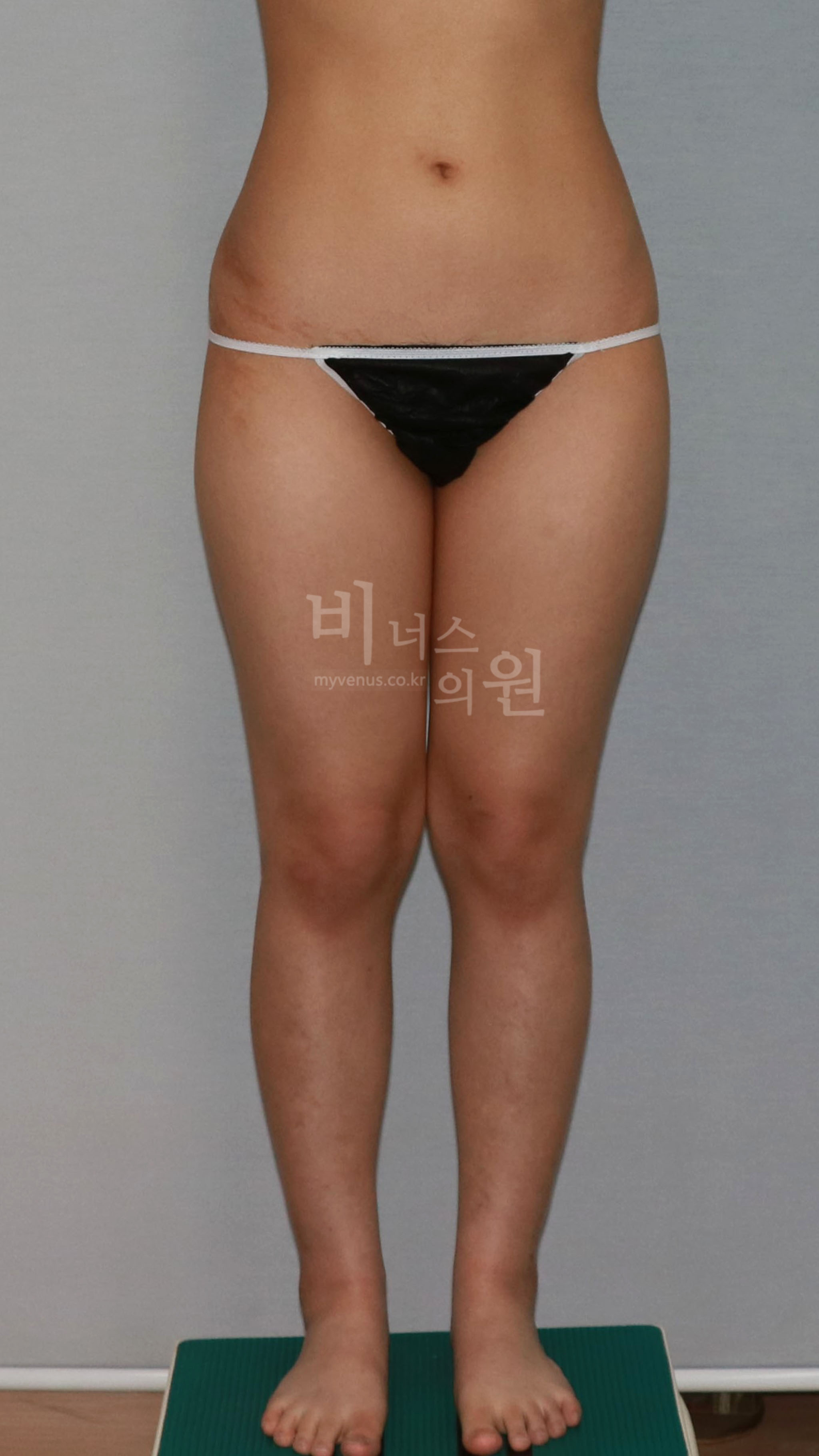 허벅지 지방흡입 수술 전 정면 비너스의원