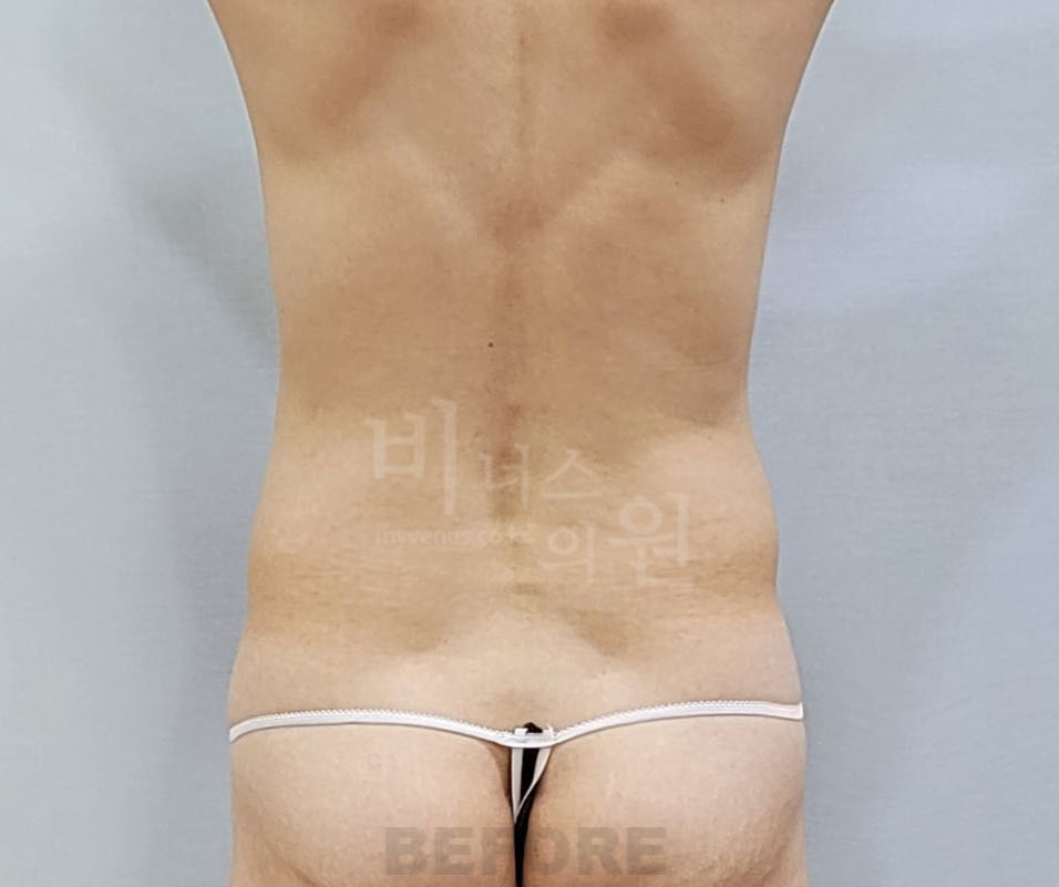 복부 지방흡입 수술 전 후면 비너스의원