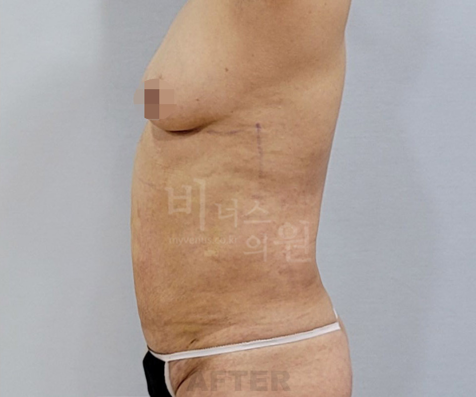 복부 지방흡입 수술 후 측면 비너스의원 — 아랫배 돌출 감소