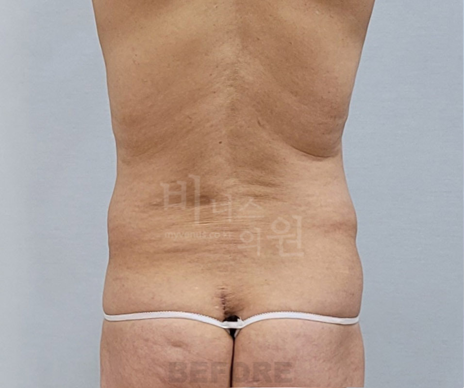 복부 지방흡입 수술 전 후면 비너스의원 — 허리 뒤쪽 윤곽