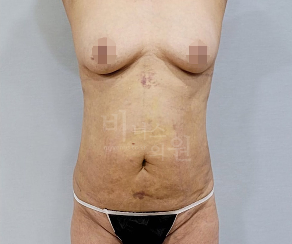 복부 지방흡입 수술 후 정면 비너스의원 — 허리 옆선 정리