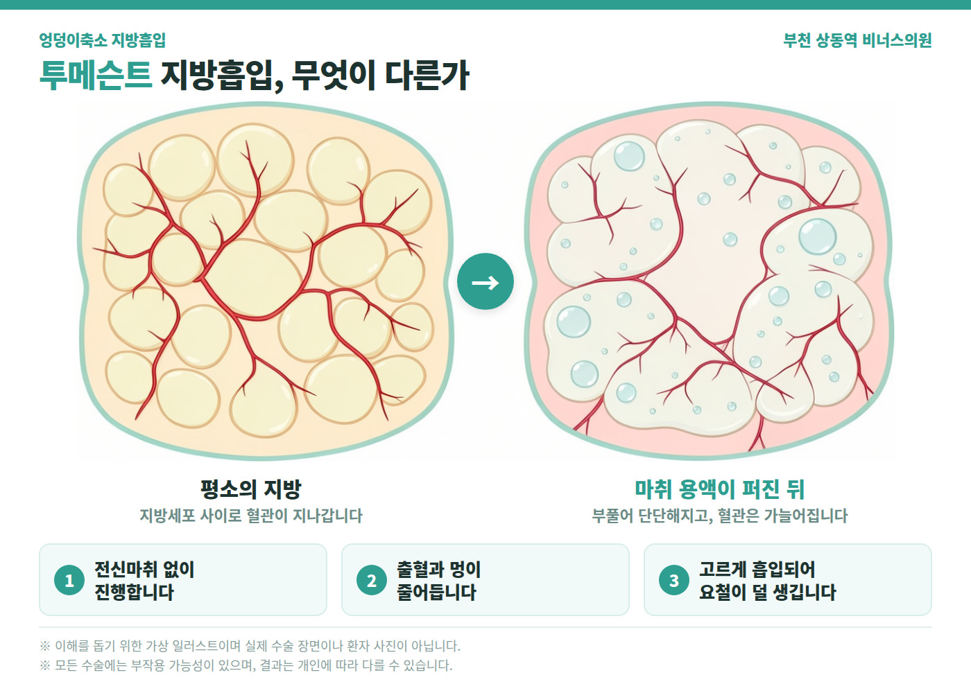 투메슨트 지방흡입 전후 지방 조직 변화 비교 의학 인포그래픽