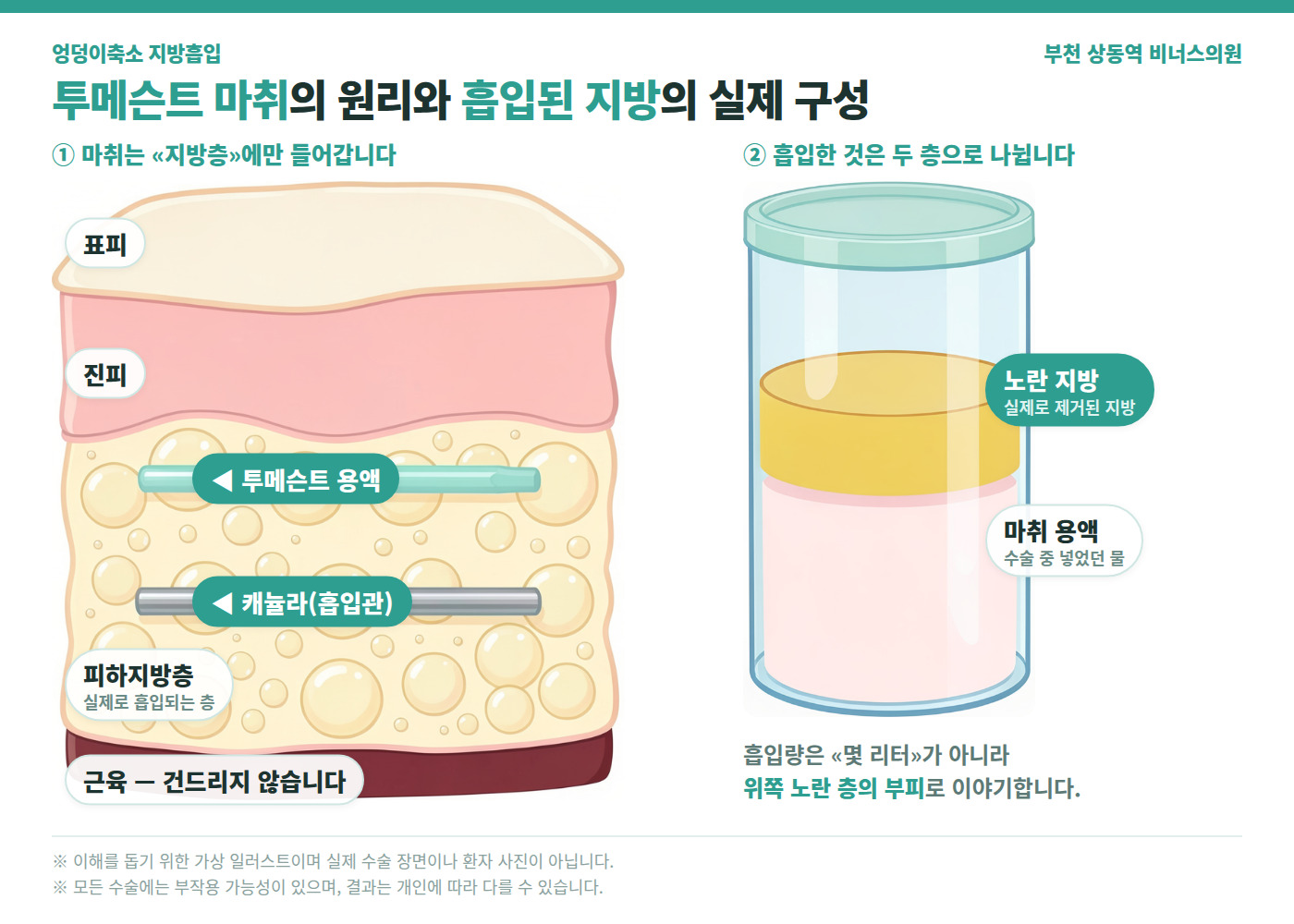 엉덩이축소 지방흡입 투메슨트 마취 원리와 흡입된 지방의 실제 구성 의학 인포그래픽