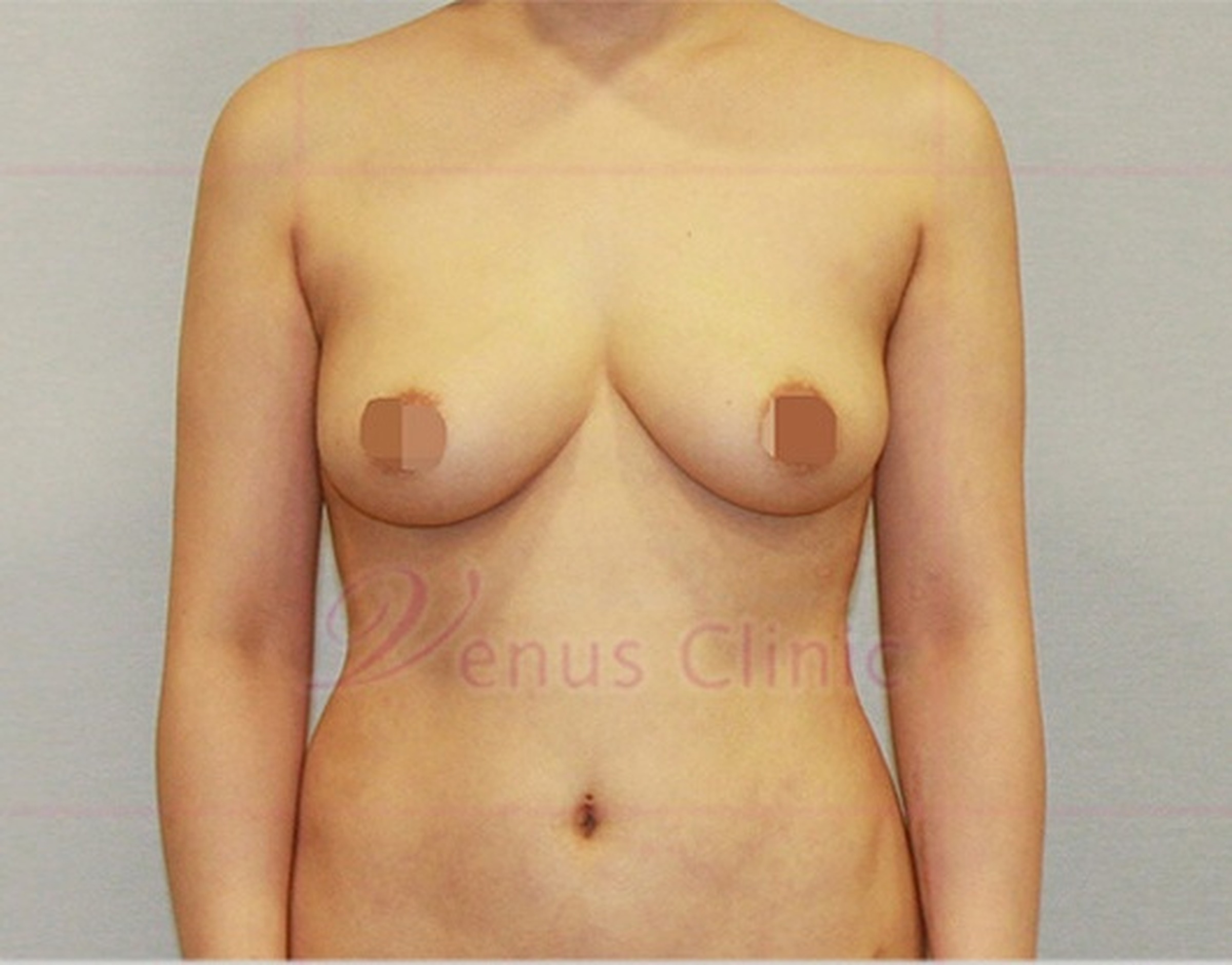 가슴축소 지방흡입 수술 후 정면 모습