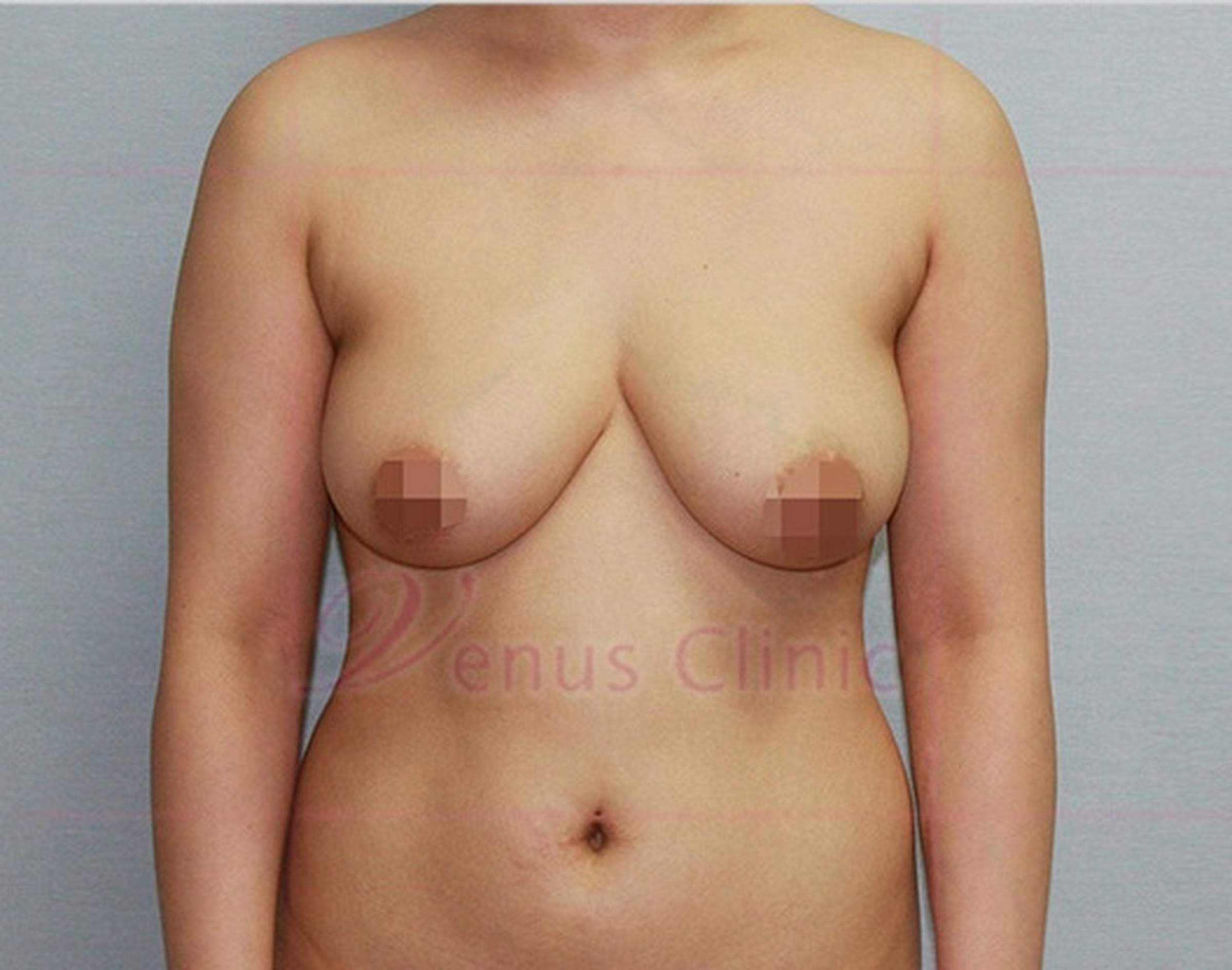 가슴축소 지방흡입 수술 전 정면 모습