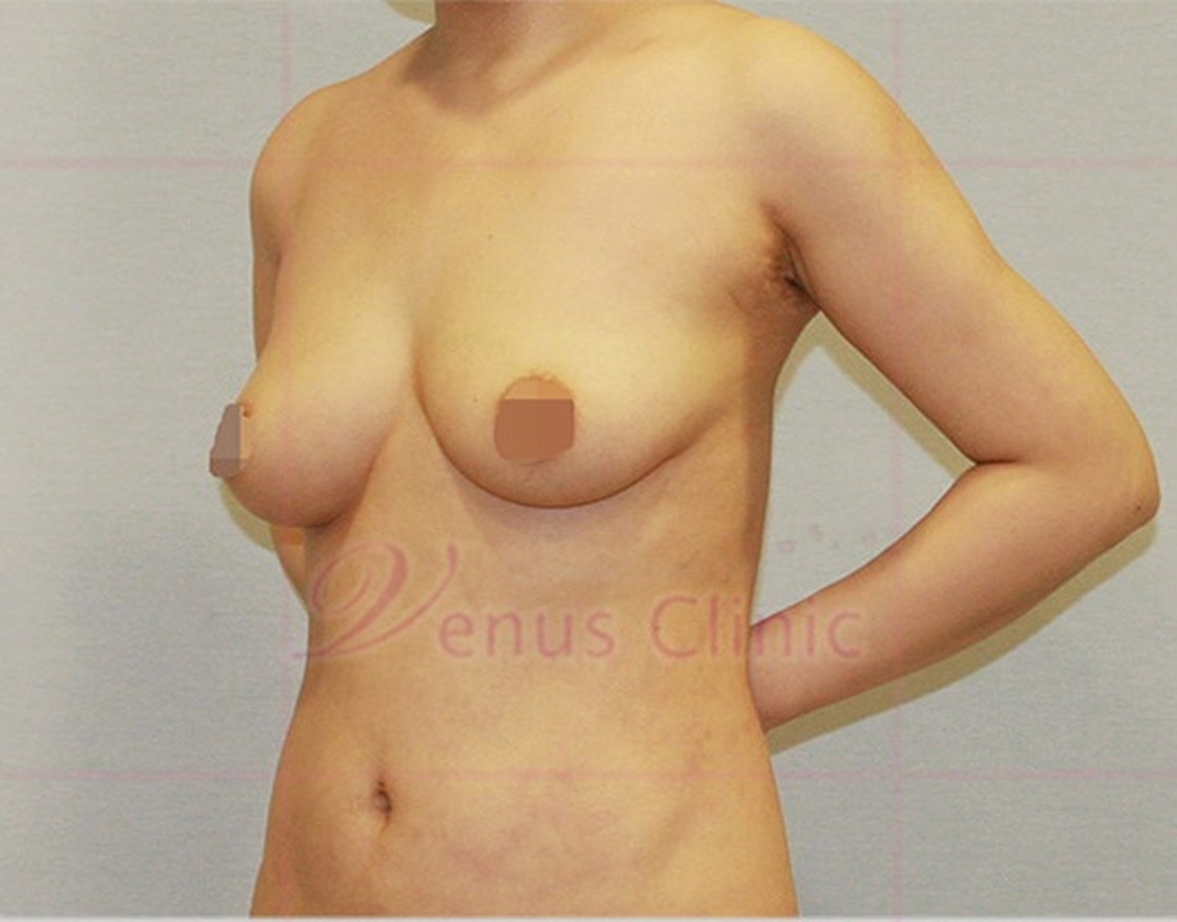 가슴축소 지방흡입 수술 후 좌측면 모습