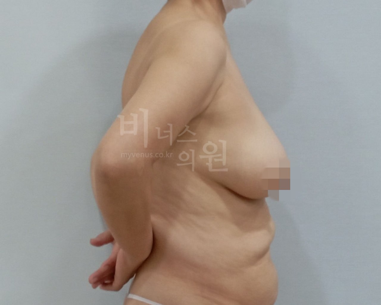복부 지방흡입 수술 전 (3)
