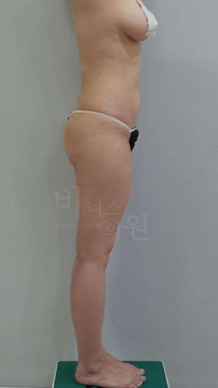 엉덩이 수술 후 측면