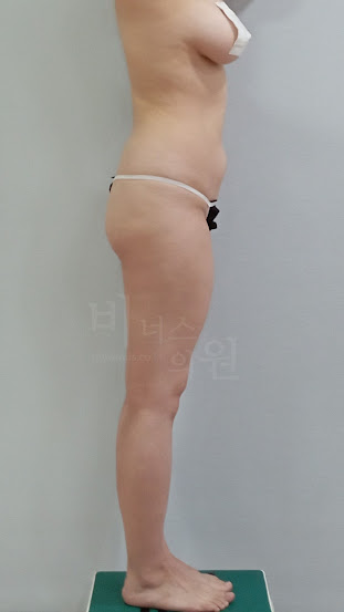 엉덩이 수술 전 측면