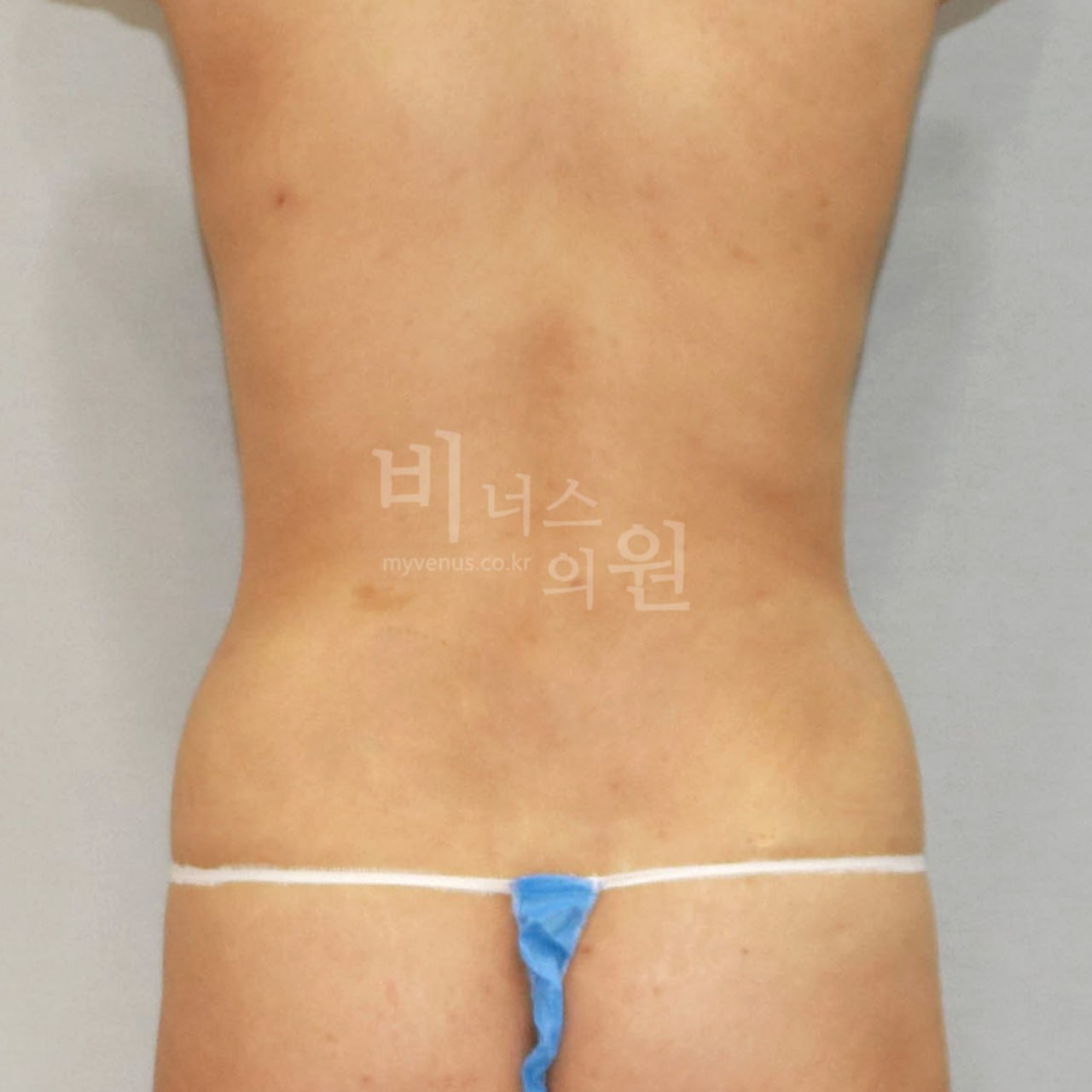 흉복부 지방흡입 수술 전 후면 비너스의원