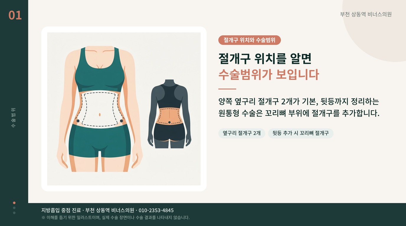 뱃살지방흡입 절개구 위치와 수술범위 인포그래픽 비너스의원