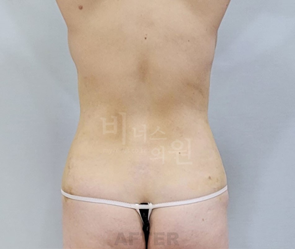 뱃살지방흡입 수술 후 뒷모습 비너스의원