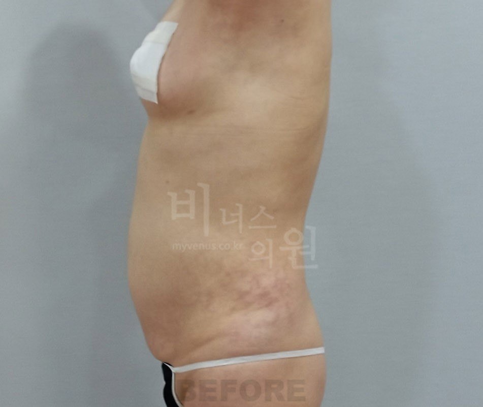흉복부 지방흡입 수술 전 측면 비너스의원