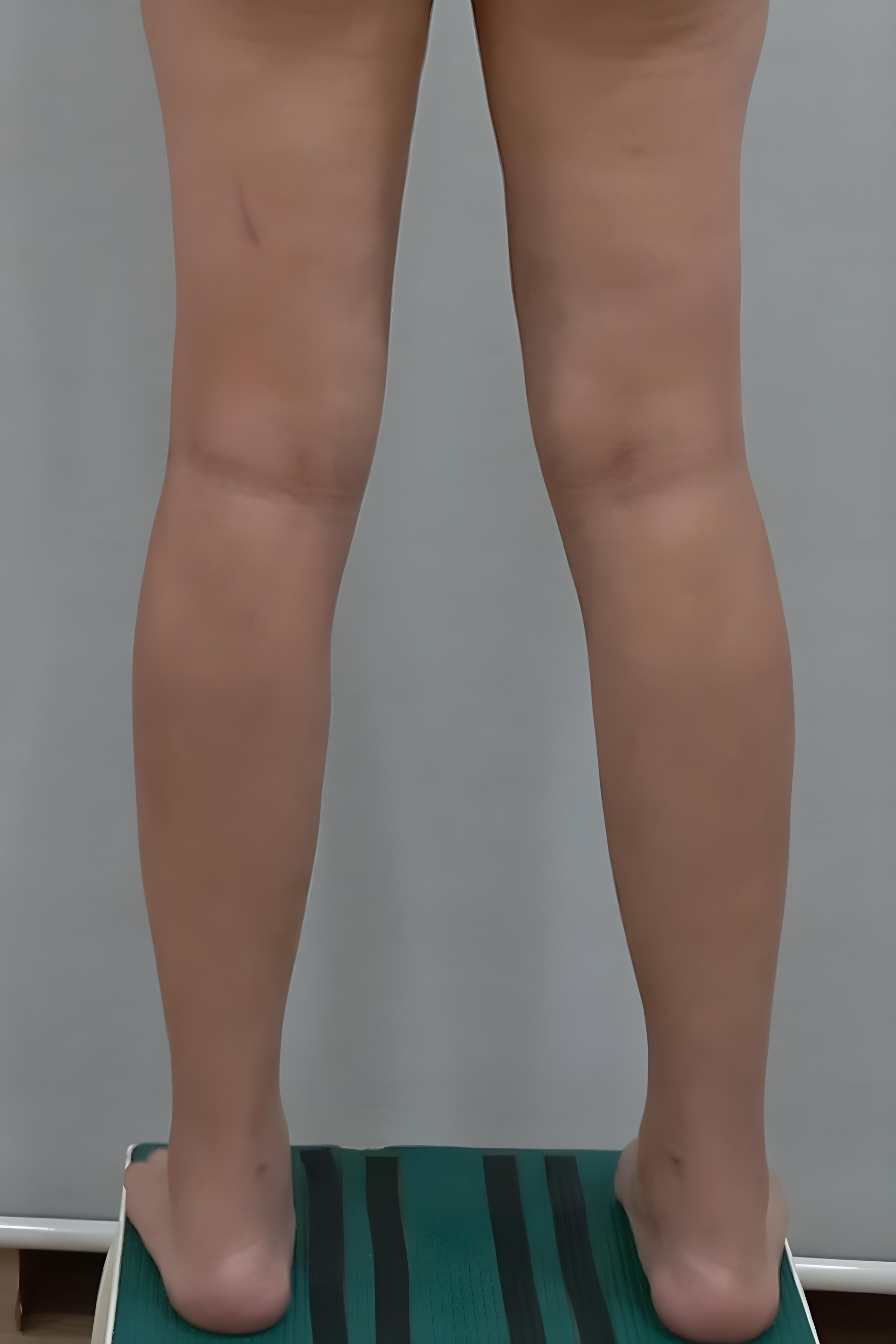 종아리 지방흡입 수술 후 후면 비너스의원