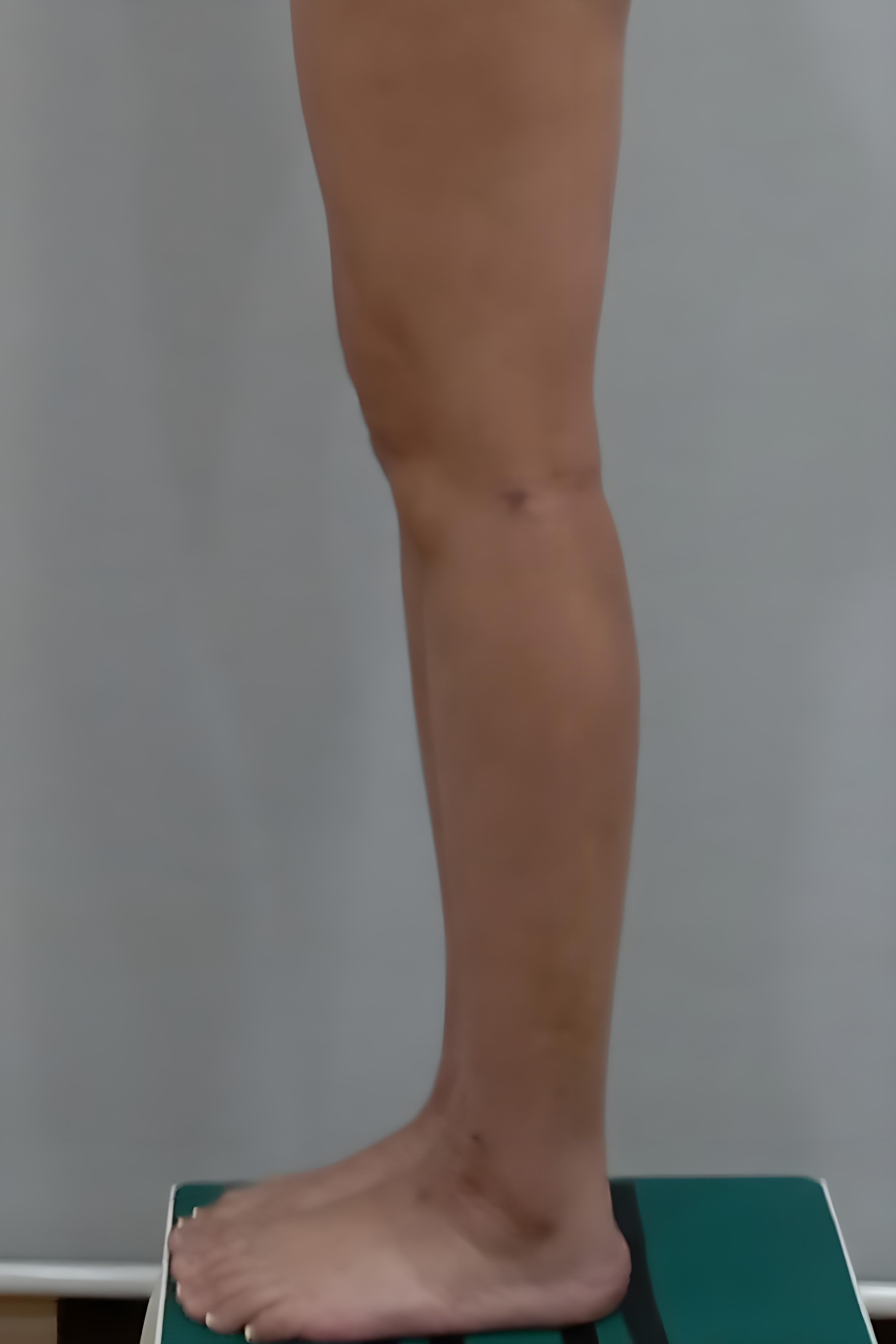 종아리 지방흡입 수술 후 측면 비너스의원