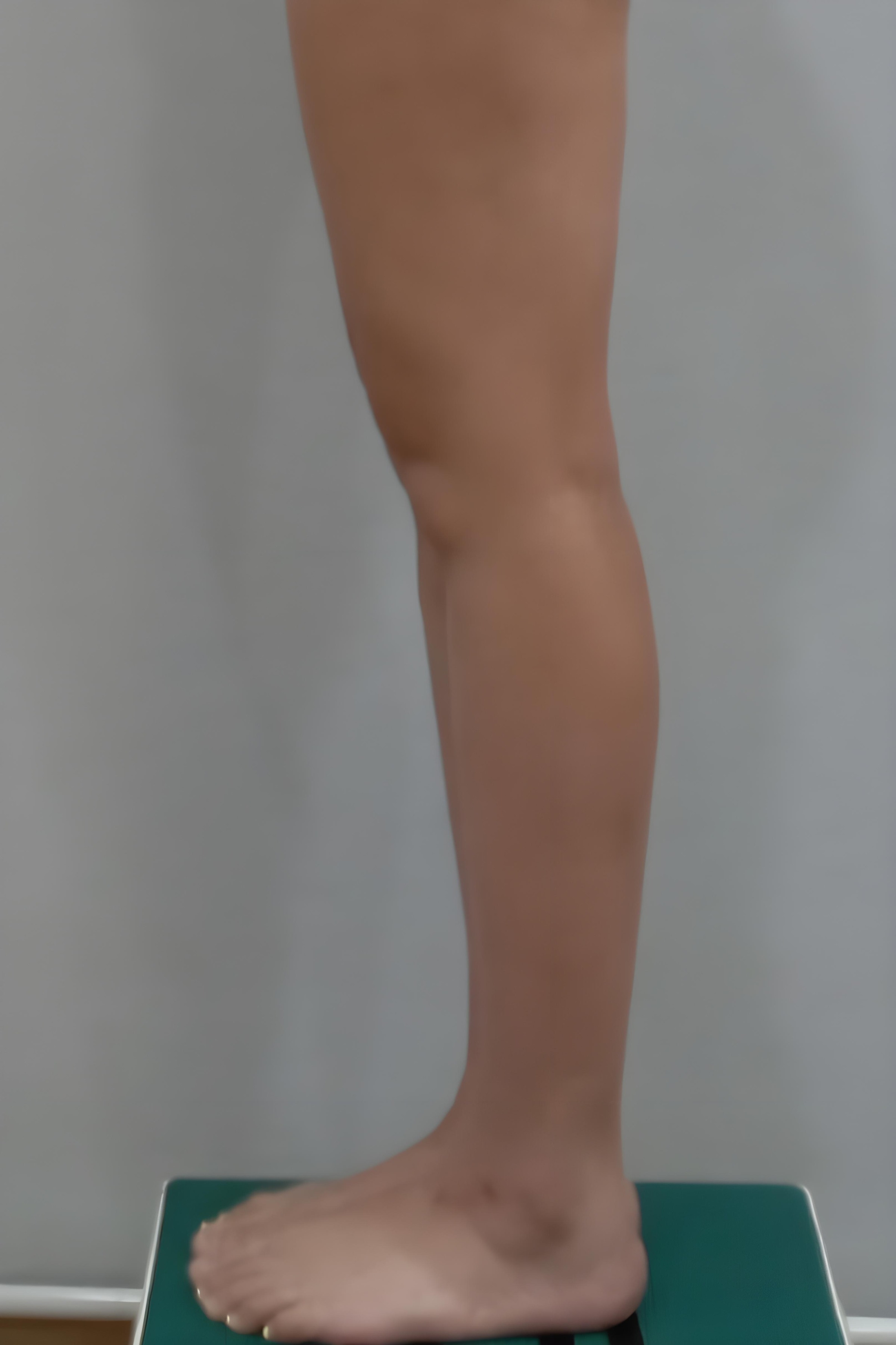 종아리 지방흡입 수술 전 측면 비너스의원