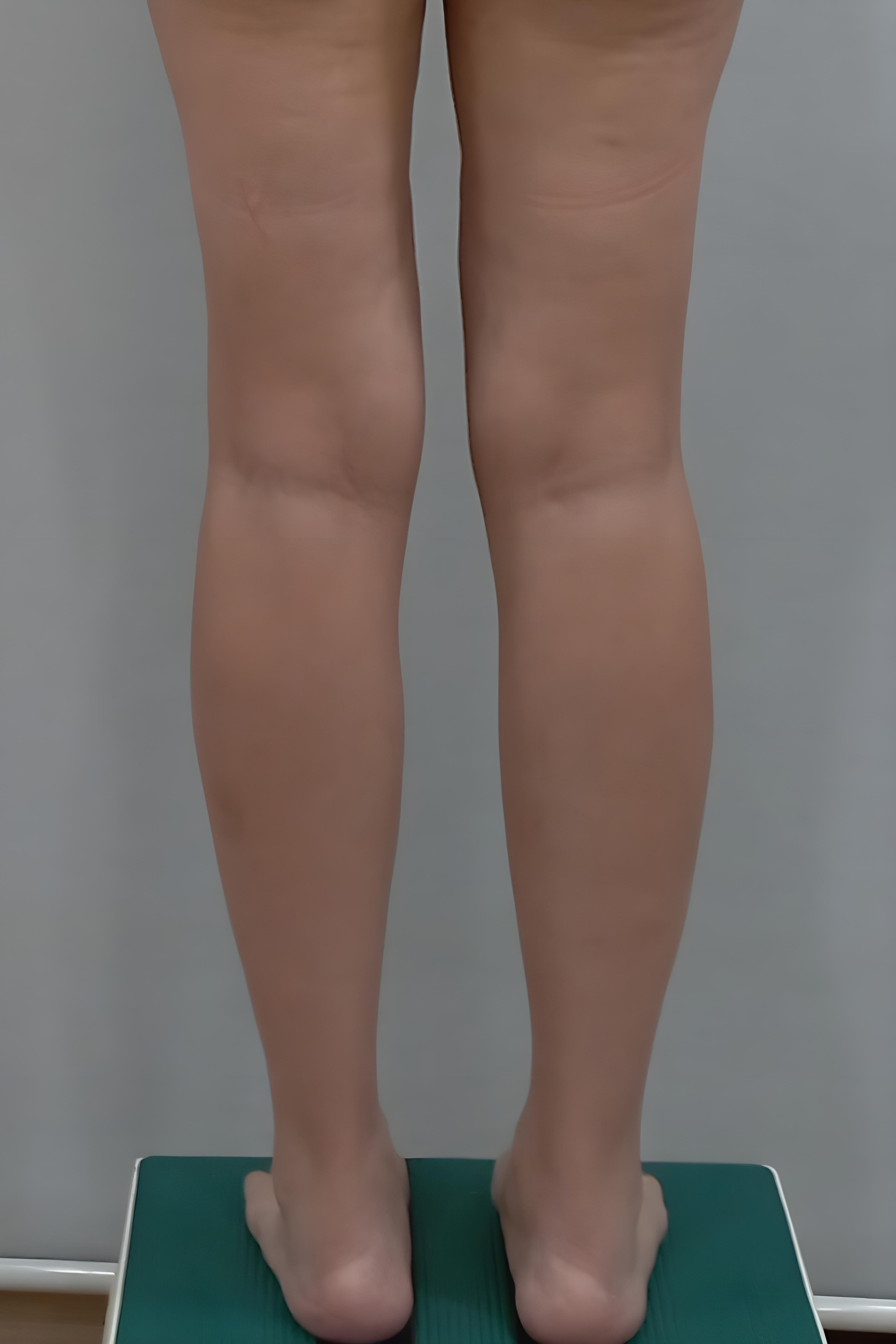 종아리 지방흡입 수술 전 후면 비너스의원