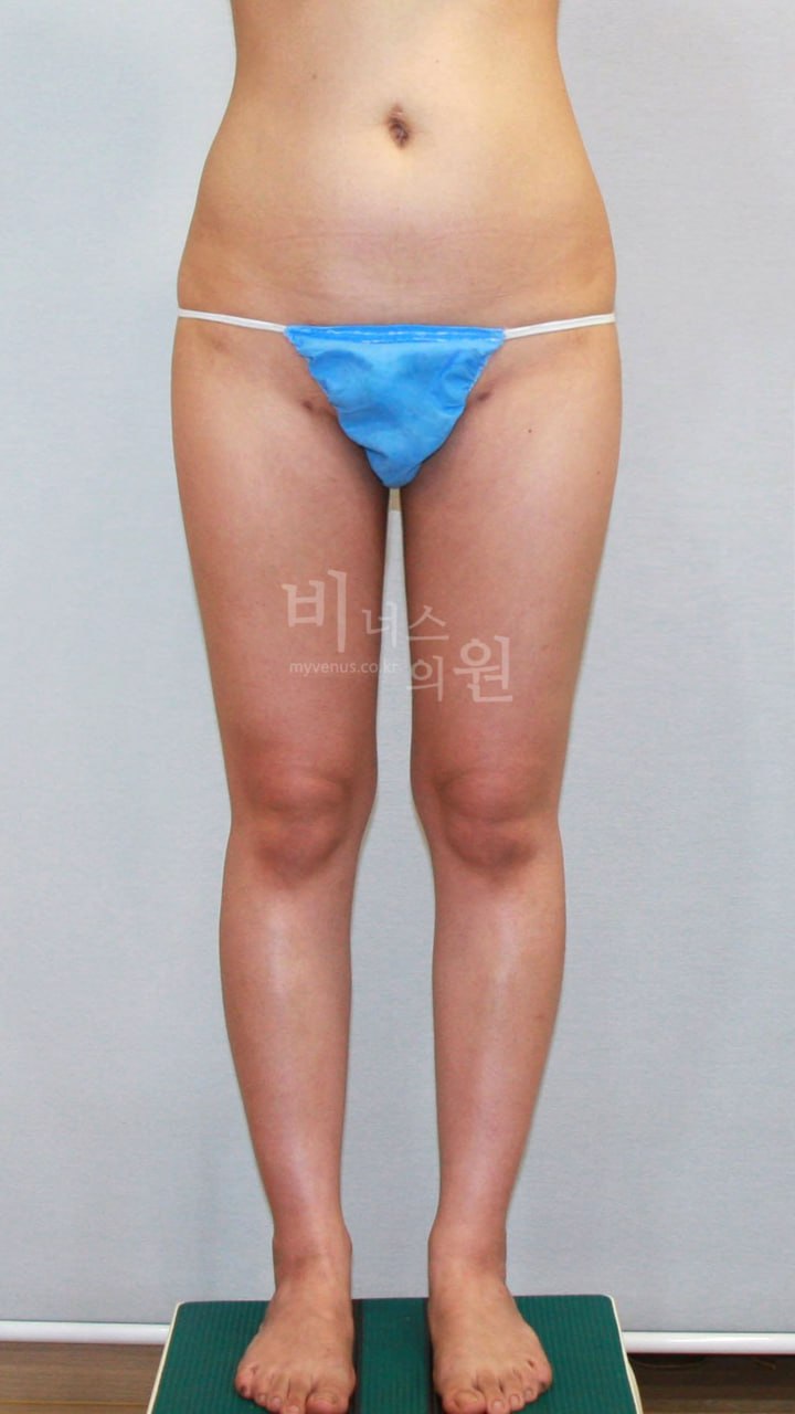 엉덩이 지방흡입 수술 후 정면 허벅지 라인 변화 비너스의원