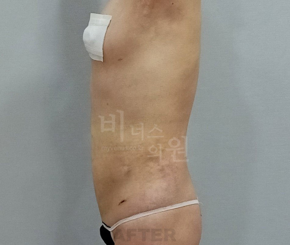 흉복부 지방흡입 수술 후 측면 비너스의원
