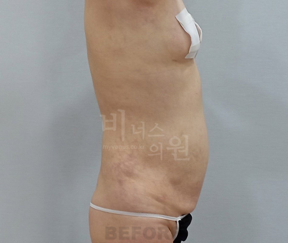 흉복부 지방흡입 수술 전 측면 비너스의원