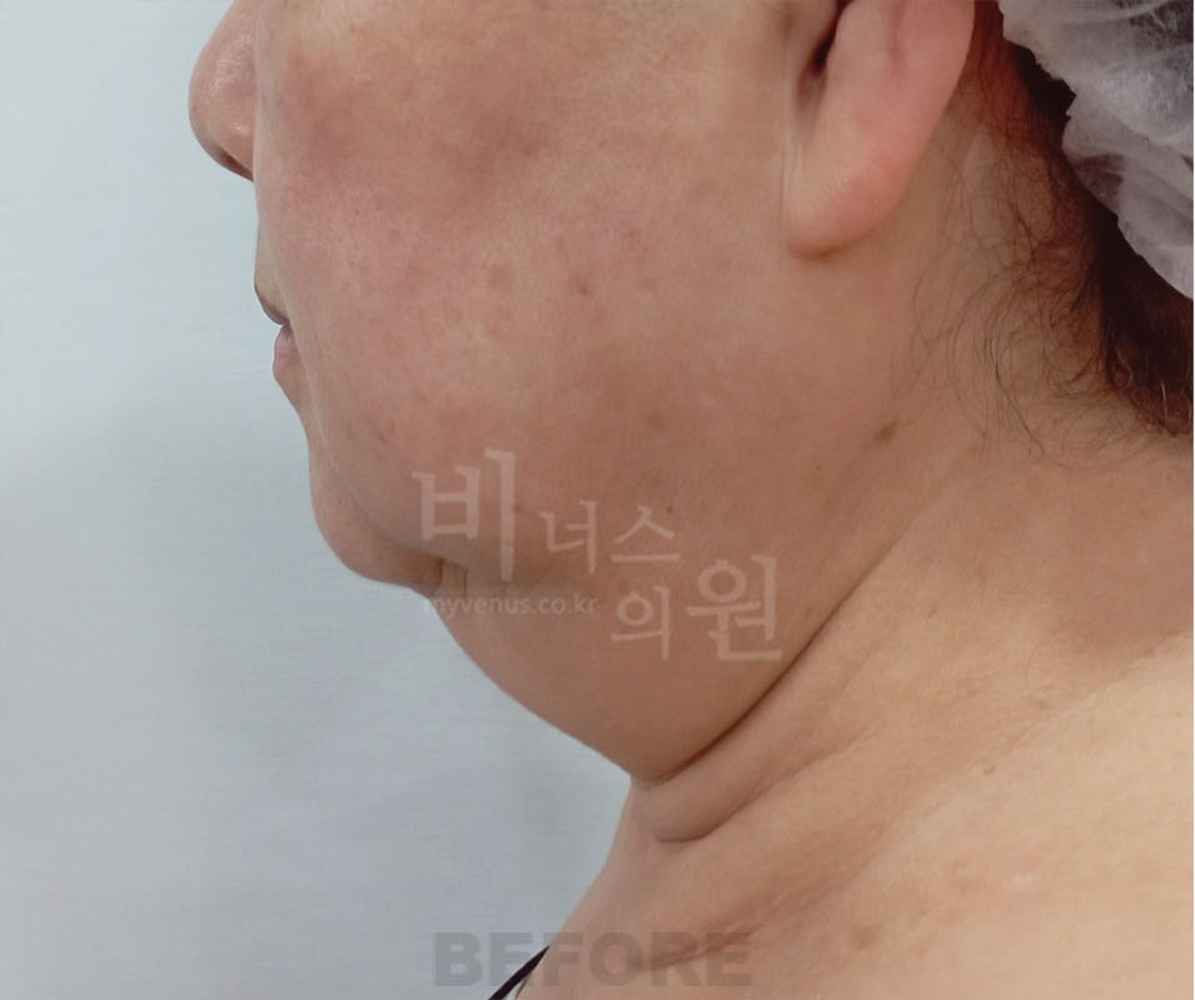 이중턱 지방흡입 수술 전 우측면