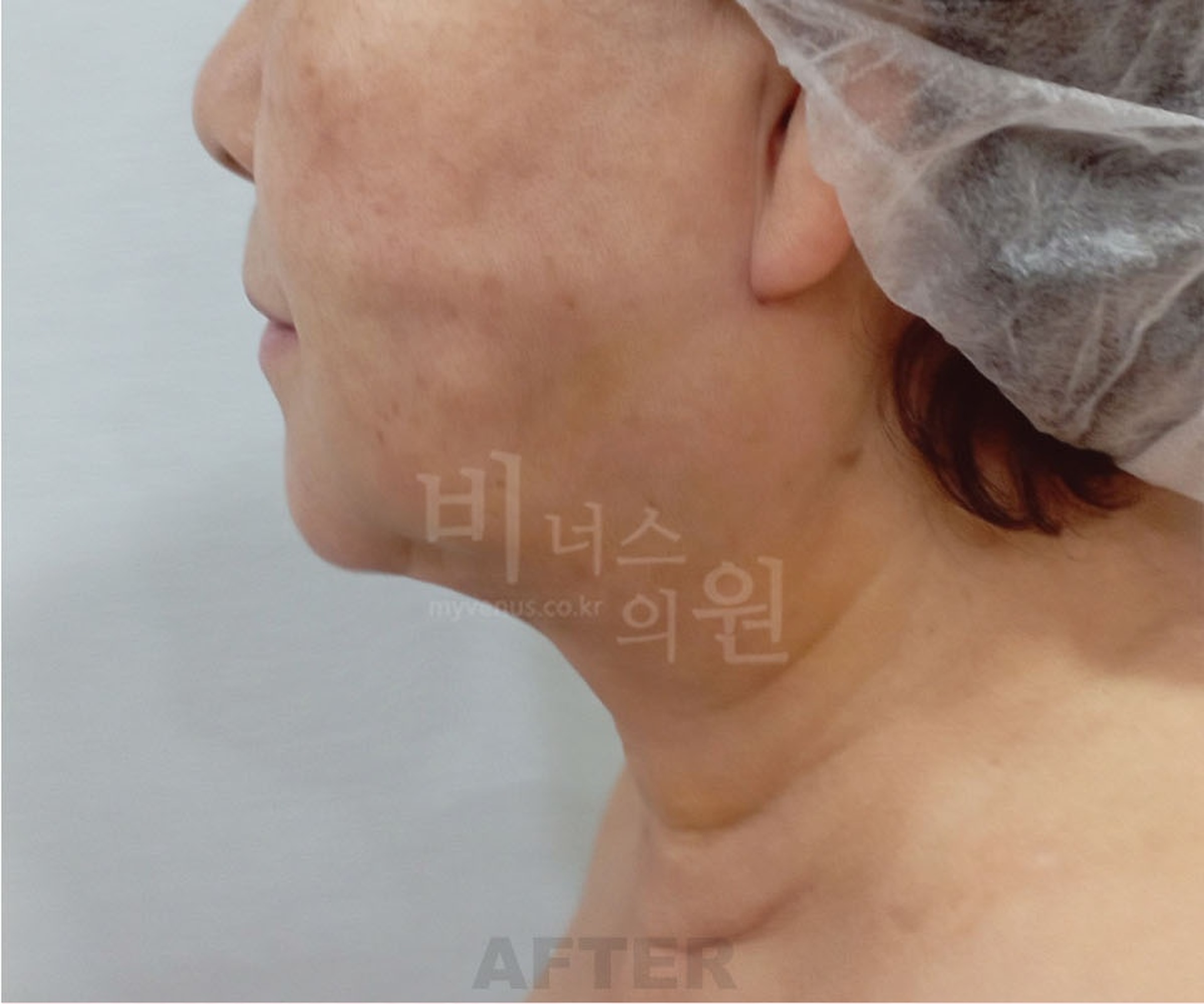 이중턱 지방흡입 수술 후 우측면