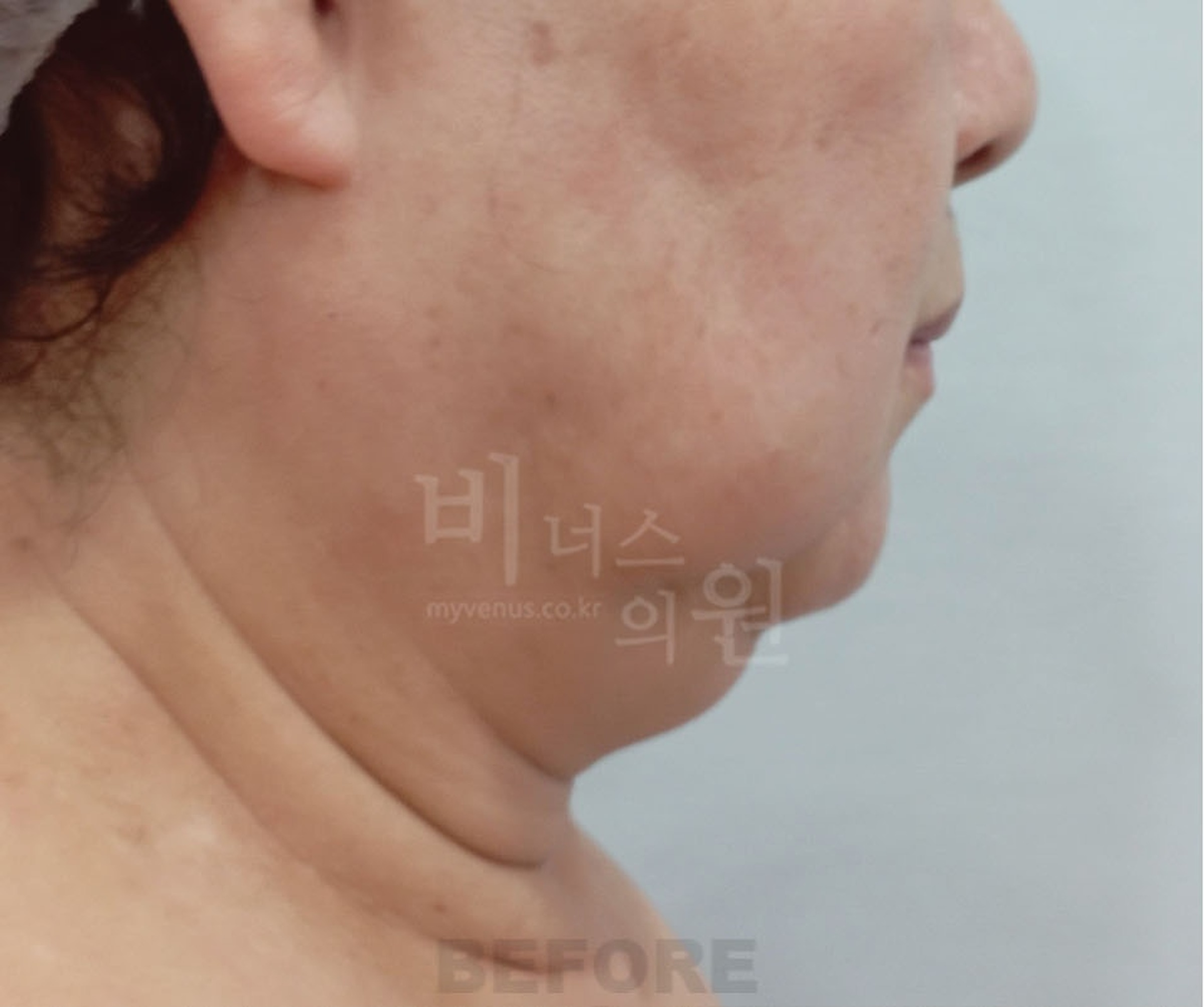 이중턱 지방흡입 수술 전 좌측면