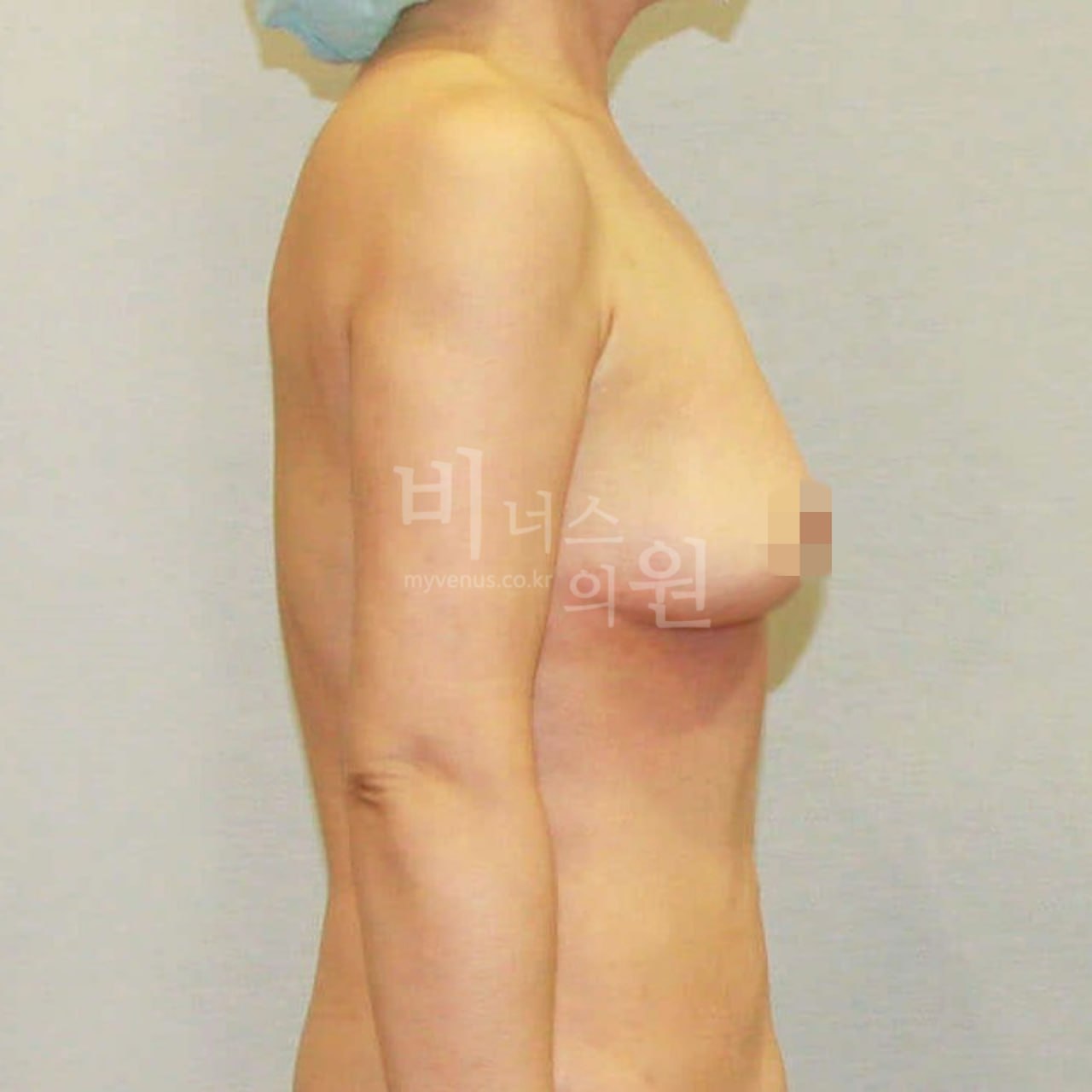 가슴축소_왼측_후 비너스의원