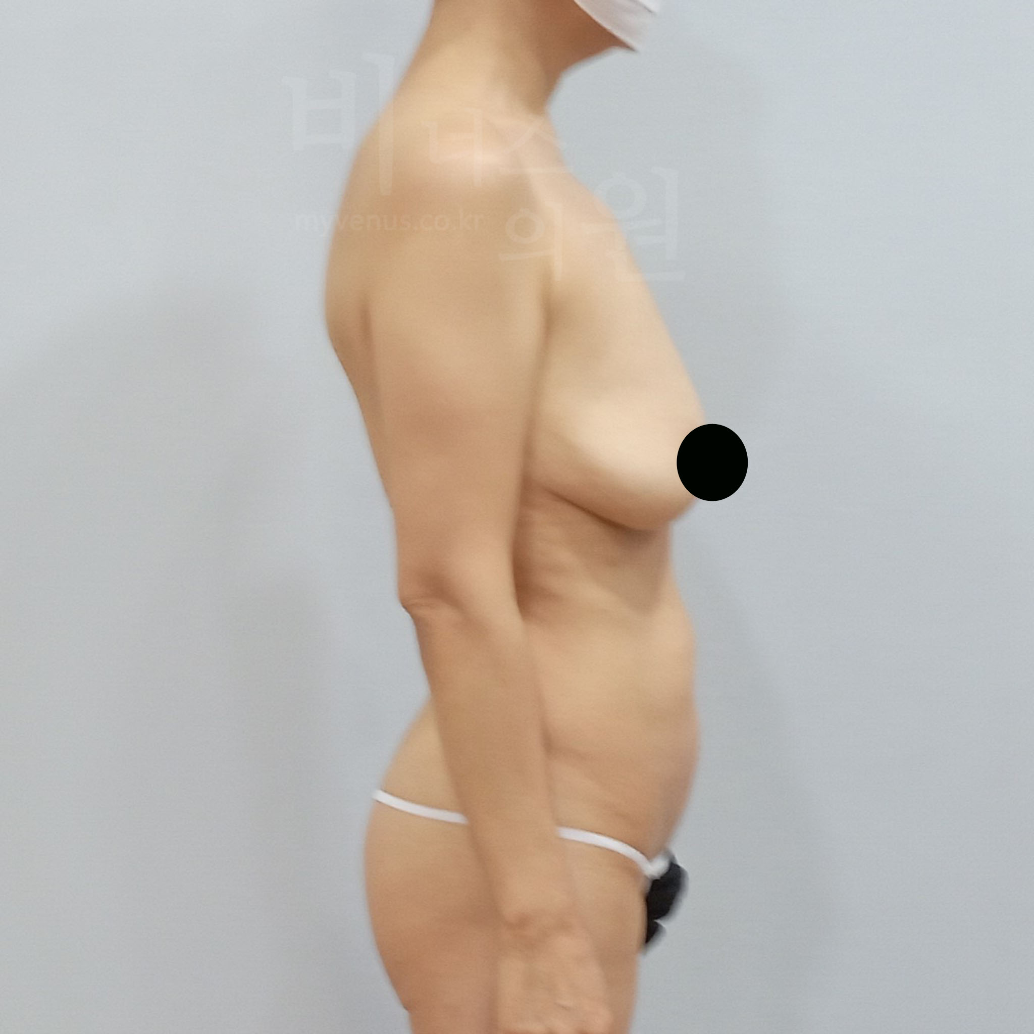 가슴축소 지방흡입 수술 전 측면